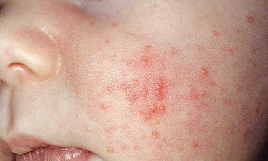 KidsCare SMV04 (KC) Scaun de masa bebelusi - Dermatite bimbi