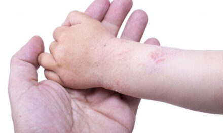 Eczema nel bambino