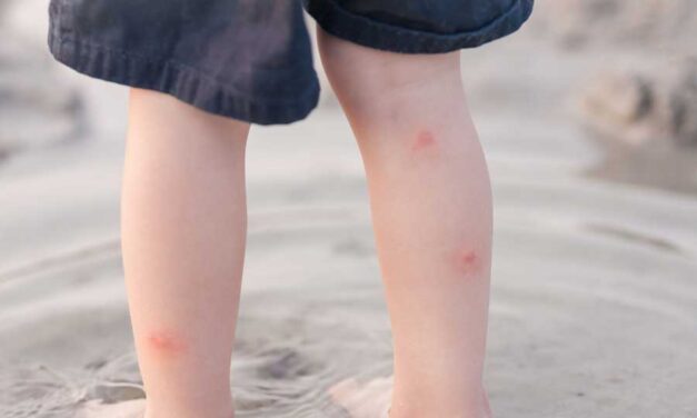 Punture di zanzare: i consigli del naturopata